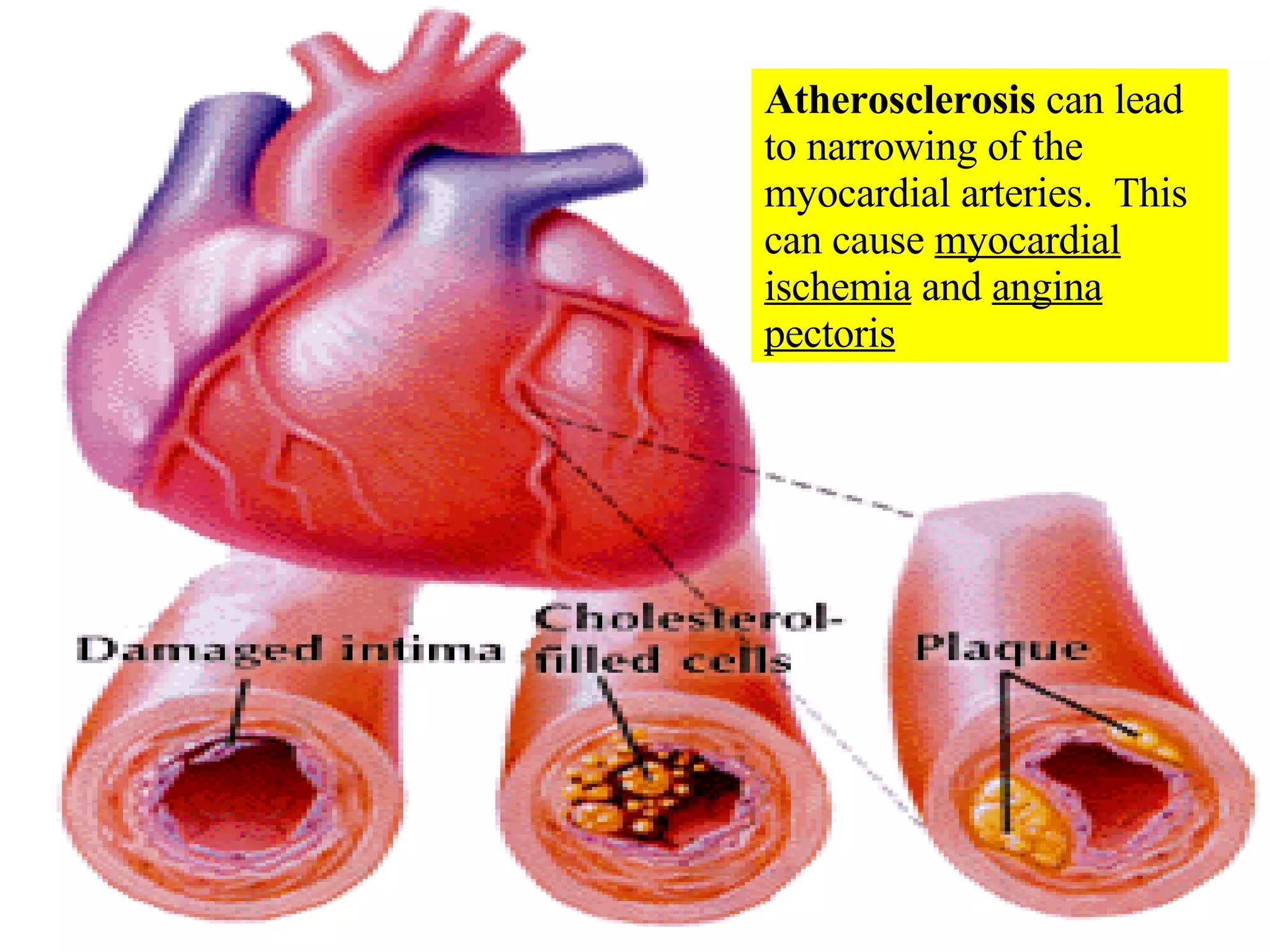 Atherosclerosis  can lead to narrowing of the myocardial arteries.  This can cause  myocardial ischemia  and  angina pectoris 
