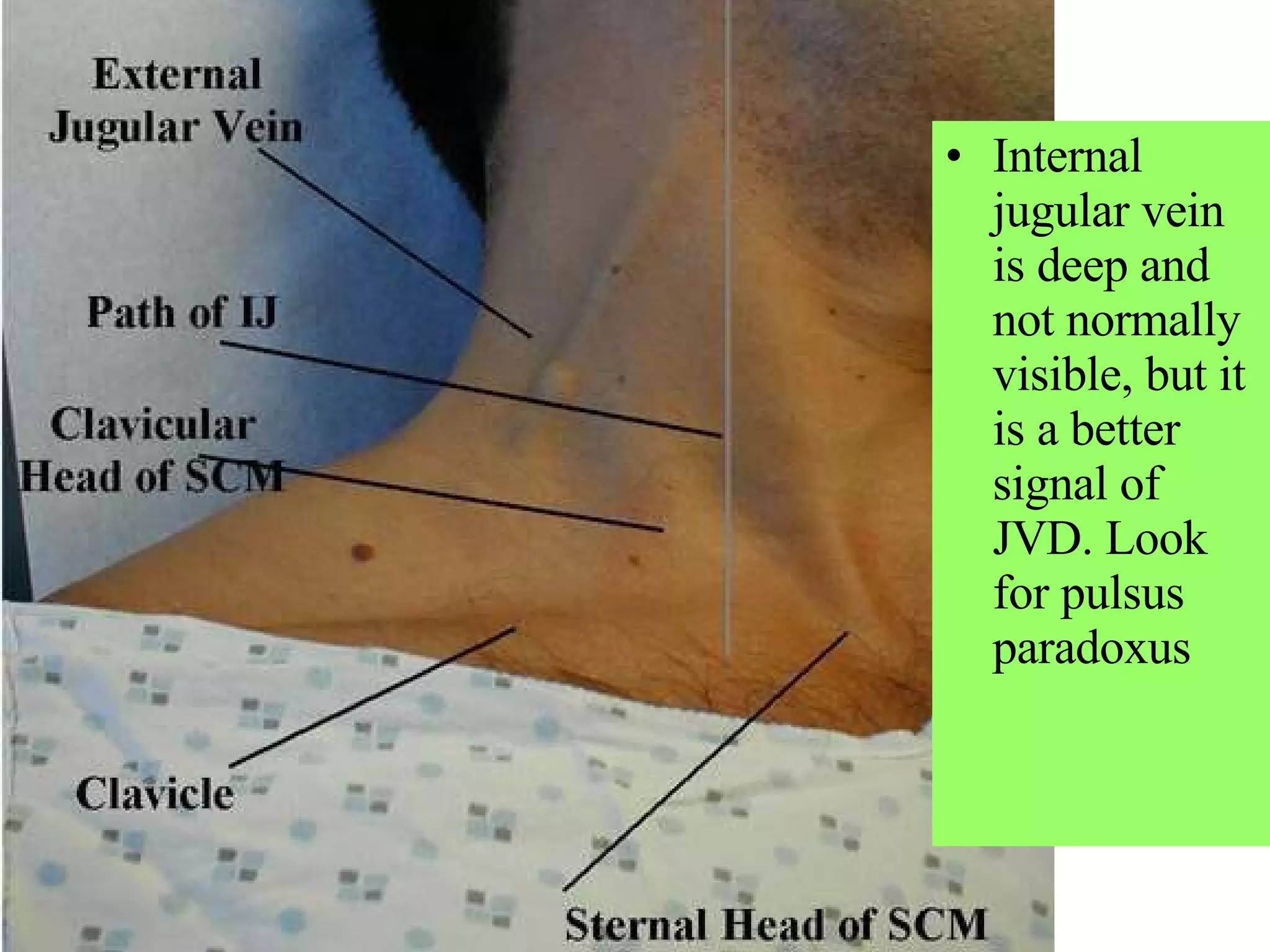 Internal jugular vein is deep and not normally visible, but it is a better signal of JVD. Look for pulsus paradoxus 