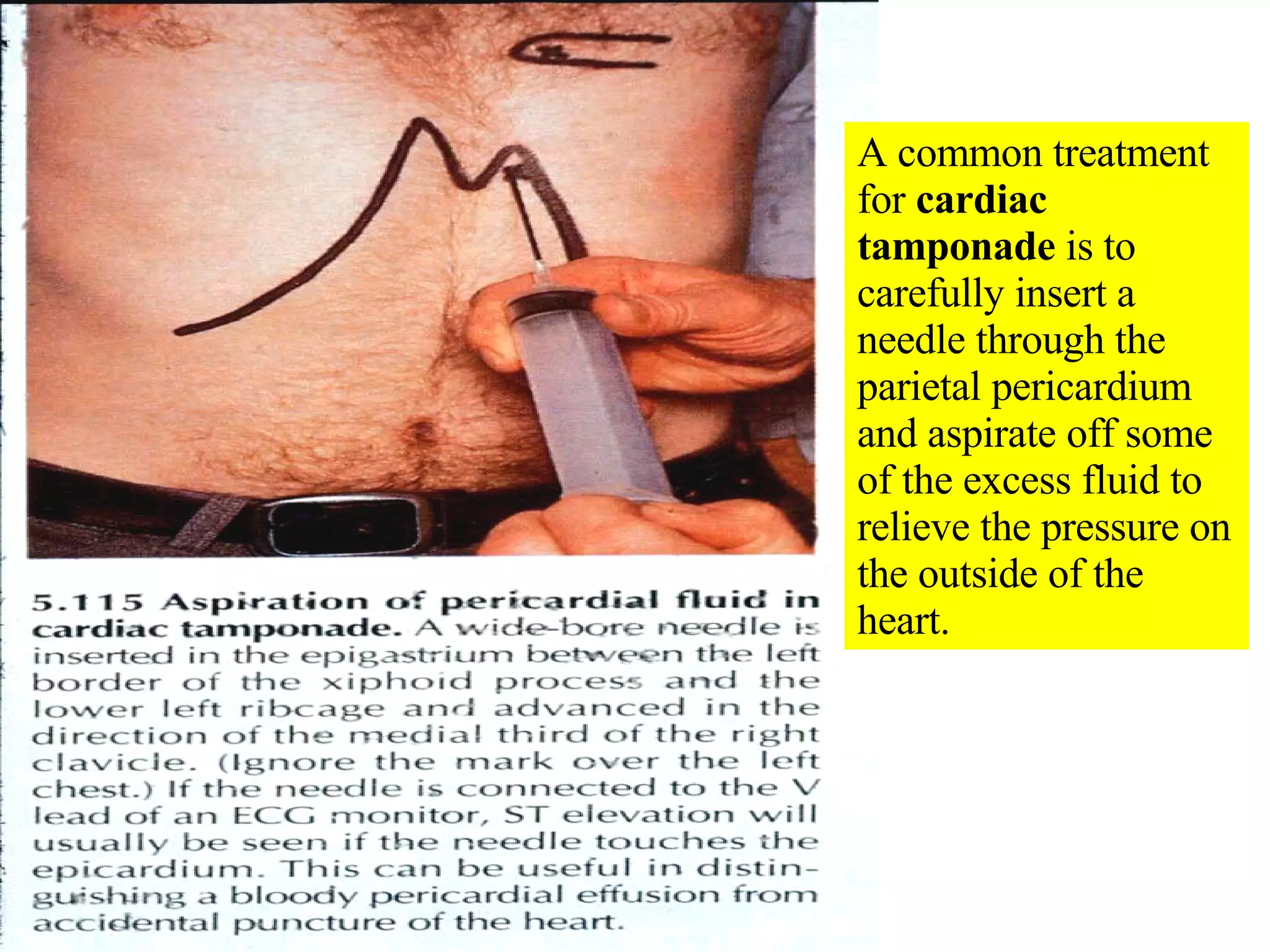 A common treatment for  cardiac tamponade  is to carefully insert a needle through the parietal pericardium and aspirate off some of the excess fluid to relieve the pressure on the outside of the heart. 