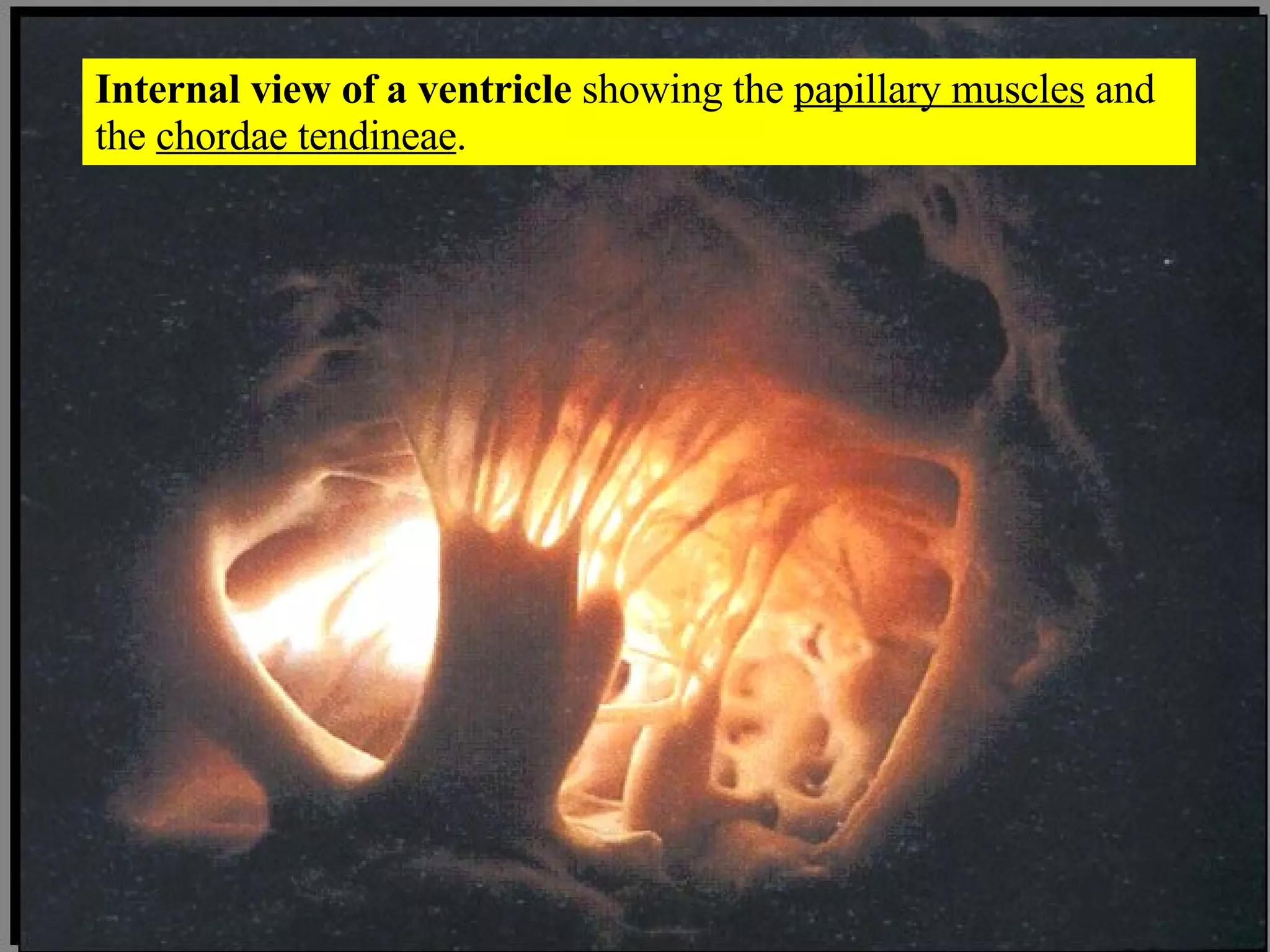 Internal view of a ventricle  showing the  papillary muscles  and the  chordae tendineae . 