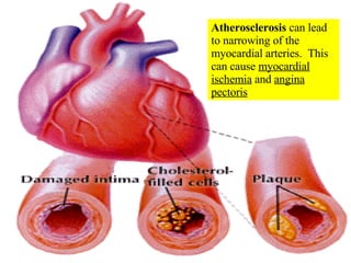 Atherosclerosis  can lead to narrowing of the myocardial arteries.  This can cause  myocardial ischemia  and  angina pectoris 