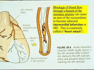 Blockage of blood flow through a branch of the coronary arteries  can cause an area of the myocardium to become infarcted  (myocardial infarction  or MI).  This is commonly called a  “heart attack”. 