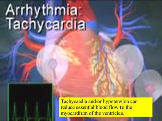 Tachycardia and/or hypotension can reduce essential blood flow to the myocardium of the ventricles. 