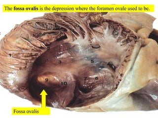Fossa ovalis The  fossa ovalis  is the depression where the foramen ovale used to be. 
