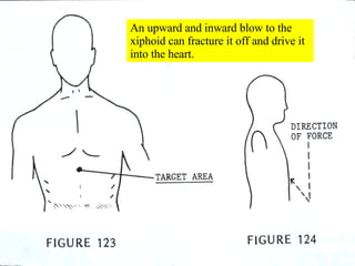 An upward and inward blow to the xiphoid can fracture it off and drive it into the heart. 