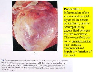 Pericarditis  is inflammation of the visceral and parietal layers of the serous pericardium, usually accompanied by excess fluid between the two membranes.  This excess fluid can cause  pressure on the heart  (cardiac tamponade) and impair the function of the heart. 