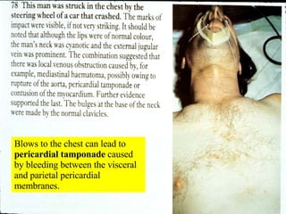 Blows to the chest can lead to  pericardial tamponade  caused by bleeding between the visceral and parietal pericardial membranes. 