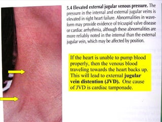 If the heart is unable to pump blood properly, then the venous blood traveling towards the heart backs up.  This will lead to external  jugular vein distention (JVD).   One cause of JVD is cardiac tamponade. 