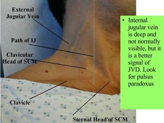 Internal jugular vein is deep and not normally visible, but it is a better signal of JVD. Look for pulsus paradoxus 