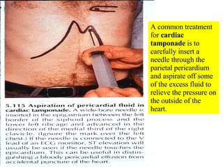 A common treatment for  cardiac tamponade  is to carefully insert a needle through the parietal pericardium and aspirate off some of the excess fluid to relieve the pressure on the outside of the heart. 