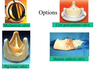 Options Mechanical valve Cow pericardium valve Pig tissue valve Human cadaver valve 