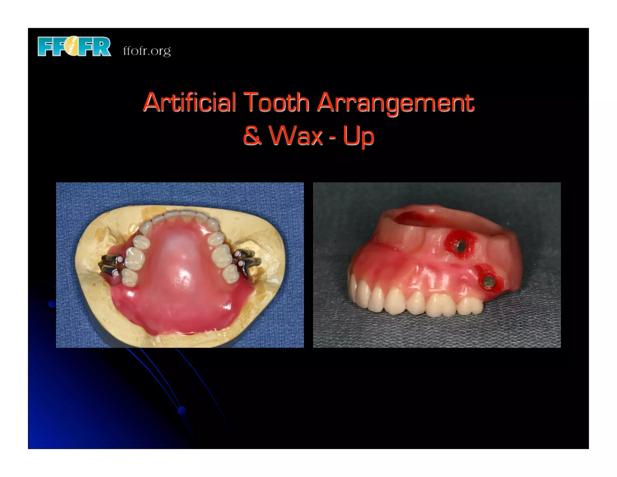 17 new implant Retained Maxillary Obturators PDF