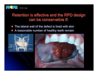 17. (new)implant retained maxillary obturators | PDF