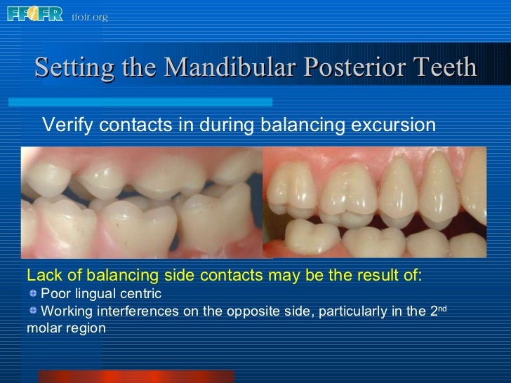 17.occlusal schemes anatomic and semiamatomic occlusion
