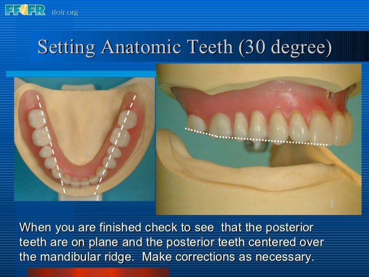 teeth setting