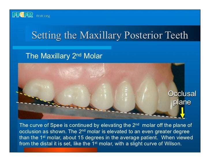 teeth setting