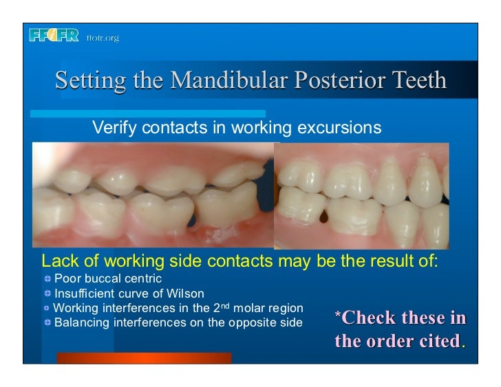 17.occlusal schemes anatomic and semiamatomic occlusion