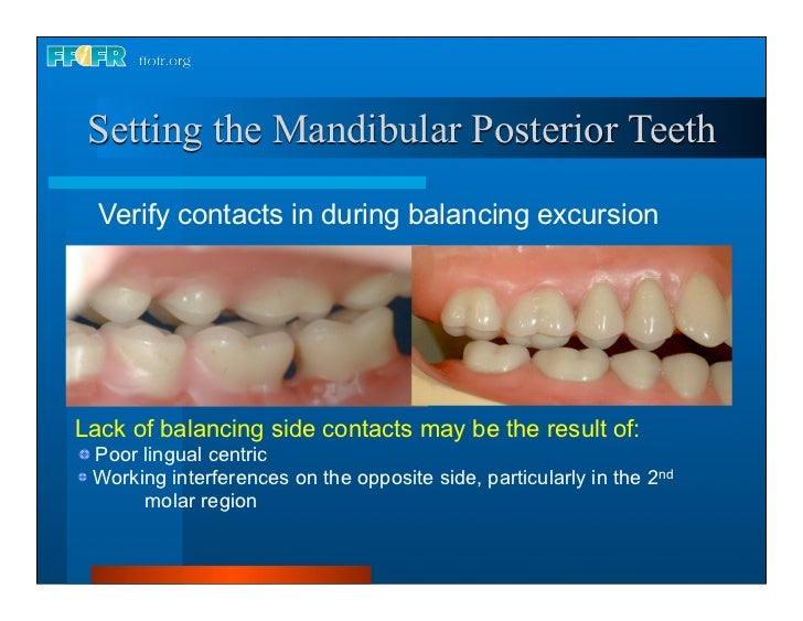 17.occlusal schemes anatomic and semiamatomic occlusion