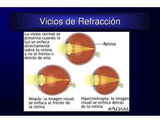 Vicios de Refracción
Vicios de Refracción
 