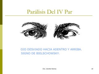 Parálisis Del IV Par OJO DESVIADO HACIA ADENTRO Y ARRIBA. SIGNO DE BIELSCHOWSKY.  