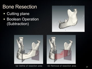 Bone Resection
 Cutting plane
 Boolean Operation
(Subtraction)
37
(a) Define of resection area (b) Removal of resection ...