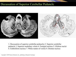 Copyright © 2005 Pearson Education, Inc., publishing as Benjamin Cummings
Decussation of Superior Cerebellar Peduncle
1. Decussation of superior cerebellar peduncles 2. Superior cerebellar
peduncle 3. Superior medullary velum 4. Fastigial nucleus 5. Globose nuclei
6. Emboliform nucleus 7. White matter of vermis 8. Dentate nucleus
 