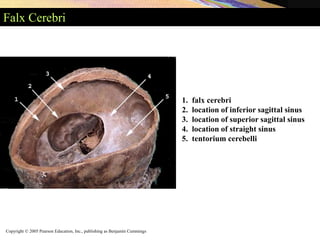 Copyright © 2005 Pearson Education, Inc., publishing as Benjamin Cummings
Falx Cerebri
1. falx cerebri
2. location of inferior sagittal sinus
3. location of superior sagittal sinus
4. location of straight sinus
5. tentorium cerebelli
 