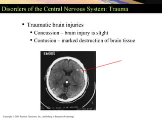 Copyright © 2005 Pearson Education, Inc., publishing as Benjamin Cummings
Disorders of the Central Nervous System: Trauma
• Traumatic brain injuries
• Concussion – brain injury is slight
• Contusion – marked destruction of brain tissue
 