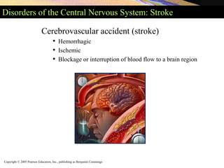 Copyright © 2005 Pearson Education, Inc., publishing as Benjamin Cummings
Disorders of the Central Nervous System: Stroke
Cerebrovascular accident (stroke)
• Hemorrhagic
• Ischemic
• Blockage or interruption of blood flow to a brain region
 