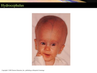 Copyright © 2005 Pearson Education, Inc., publishing as Benjamin Cummings
Hydrocephalus
 