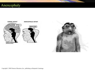 Copyright © 2005 Pearson Education, Inc., publishing as Benjamin Cummings
Anencephaly
 