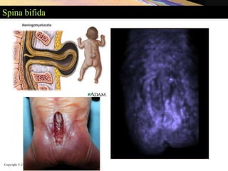 Copyright © 2005 Pearson Education, Inc., publishing as Benjamin Cummings
Spina bifida
 