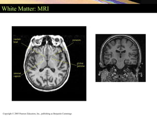 Copyright © 2005 Pearson Education, Inc., publishing as Benjamin Cummings
White Matter: MRI
 