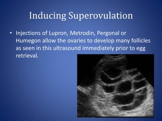 Inducing Superovulation
• Injections of Lupron, Metrodin, Pergonal or
Humegon allow the ovaries to develop many follicles
as seen in this ultrasound immediately prior to egg
retrieval.
 