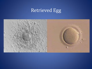 Retrieved Egg
 
