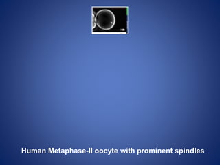 Human Metaphase-II oocyte with prominent spindles
 