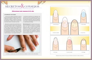 de los mejores profesionales
SECRETOS&CONSEJOS
35
2. Uñas azuladas
3. Manchas amarillas
5. Onicorrexis 6. Uñas muy rojizas 7. Onicofagia
4. Onicomicosis
1. Manchas blancas
Alteraciones más comunes con las que nos podremos encontrar en el salón de manicura.
La limpieza, el cuidado de las manos y las manicuras bien realizadas, nos evitan muchas enfermedades.
LAS ANOMALÍAS Y SUS CAUSAS
A continuación describiremos las alteraciones más
comunes con las que nos podremos encontrar en el
salón de manicura, para poder reconocerlas y decidir
los tratamientos adecuados a aplicar (si la alteración
es muy grave, lo más apropiado será derivar el caso
a un especialista/dermatólogo).
Manchas blancas (1): Por lo general, vienen provoca-
das por una deficiencia de vitaminas A y B, proteínas,
hierro, cinc y calcio. La manicuras mal efectuadas
(aquellas que dañan la cutícula) y los golpes o trau-
matismos en la matriz pueden modificar el aspecto
de las uñas cuando crecen. El continuo contacto con
productos abrasivos como detergentes y blanquea-
dores son también responsables de la aparición de
manchas blancas en las uñas.
La uñas son las ventanas más directas a través de
las que se puede apreciar el estado de la circulación y
oxigenación del organismo. Además revelan, de ma-
nera bastante acertada, la presencia de enfermeda-
des infecciosas y cardíacas, pues la mayoría de las
veces éstas cambian la coloración de las uñas.
Básicamente, las alteraciones pueden afectar el co-
lor de la uña (amarillento, azulado, rojizo, amarronado,
etc) el grosor, la textura, el brillo, y su implantación en
el lecho ungueal. Todo esto puede ser orginado tanto
por enfermedades micóticas (ocasionadas por hon-
gos), bacterianas o también por las manicuras agresi-
vas, los productos detergentes, los malos cosméticos,
los quitaesmaltes mal formulados, abrasivos, ciertas
sustancias alérgicas e incluso golpes accidentales.
Alteraciones más comunes de la uña
 