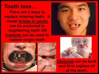 Tooth loss…
There are 3 ways to
replace missing teeth: A
dental bridge or pontic
can be anchored to
neighboring teeth OR
implants can be used to
replace single teeth.
Dentures can be built
and fit to replace all
of the teeth.
 