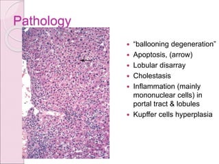 Pathology
 “ballooning degeneration”
 Apoptosis, (arrow)
 Lobular disarray
 Cholestasis
 Inflammation (mainly
mononuclear cells) in
portal tract & lobules
 Kupffer cells hyperplasia
 