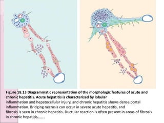 10/10/2023
Figure 18.13 Diagrammatic representation of the morphologic features of acute and
chronic hepatitis. Acute hepatitis is characterized by lobular
inflammation and hepatocellular injury, and chronic hepatitis shows dense portal
inflammation. Bridging necrosis can occur in severe acute hepatitis, and
fibrosis is seen in chronic hepatitis. Ductular reaction is often present in areas of fibrosis
in chronic hepatitis.
 