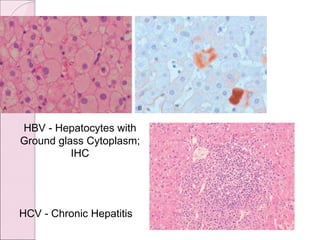 HCV - Chronic Hepatitis
HBV - Hepatocytes with
Ground glass Cytoplasm;
IHC
 
