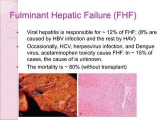 Fulminant Hepatic Failure (FHF)
 Viral hepatitis is responsible for ~ 12% of FHF; (8% are
caused by HBV infection and the rest by HAV)
 Occasionally, HCV, herpesvirus infection, and Dengue
virus, acetaminophen toxicity cause FHF. In ~ 15% of
cases, the cause of is unknown.
 The mortality is ~ 80% (without transplant)
 