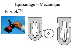 Epissurage – Mécanique
FibrlokTM
 