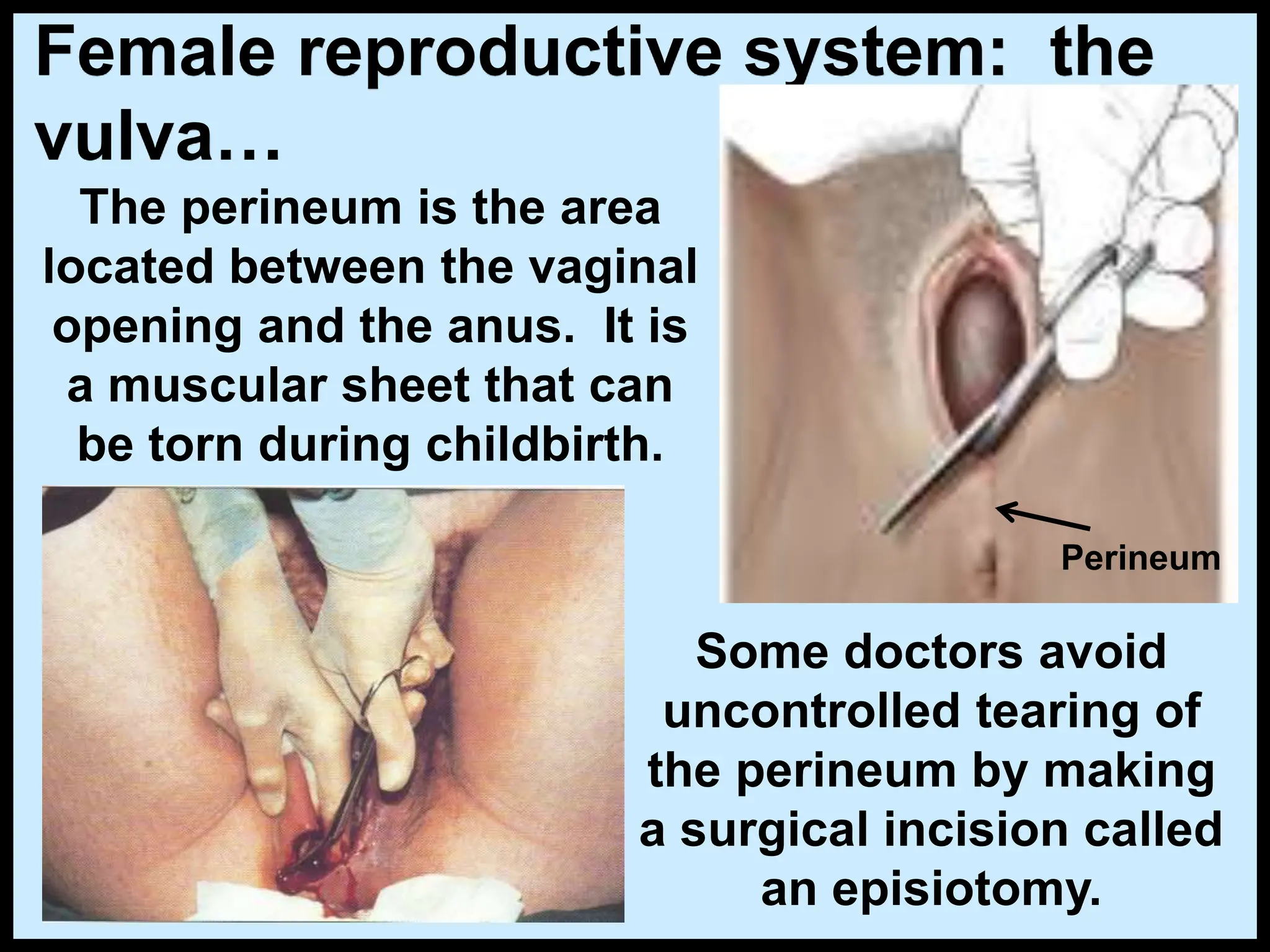 The perineum is the area
located between the vaginal
opening and the anus. It is
a muscular sheet that can
be torn during childbirth.
Female reproductive system: the
vulva…
Some doctors avoid
uncontrolled tearing of
the perineum by making
a surgical incision called
an episiotomy.
Perineum
 