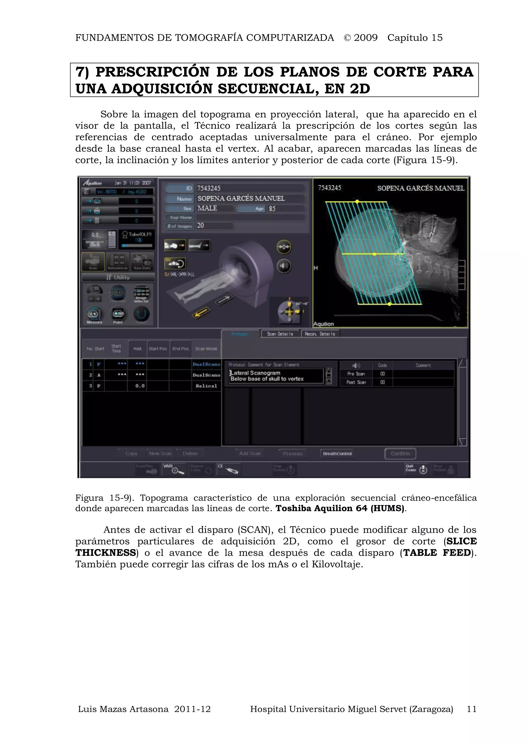 FUNDAMENTOS DE TOMOGRAFÍA COMPUTARIZADA © 2009 Capítulo 15
Luis Mazas Artasona 2011-12 Hospital Universitario Miguel Servet (Zaragoza) 11
7) PRESCRIPCIÓN DE LOS PLANOS DE CORTE PARA
UNA ADQUISICIÓN SECUENCIAL, EN 2D
Sobre la imagen del topograma en proyección lateral, que ha aparecido en el
visor de la pantalla, el Técnico realizará la prescripción de los cortes según las
referencias de centrado aceptadas universalmente para el cráneo. Por ejemplo
desde la base craneal hasta el vertex. Al acabar, aparecen marcadas las líneas de
corte, la inclinación y los límites anterior y posterior de cada corte (Figura 15-9).
Figura 15-9). Topograma característico de una exploración secuencial cráneo-encefálica
donde aparecen marcadas las líneas de corte. Toshiba Aquilion 64 (HUMS).
Antes de activar el disparo (SCAN), el Técnico puede modificar alguno de los
parámetros particulares de adquisición 2D, como el grosor de corte (SLICE
THICKNESS) o el avance de la mesa después de cada disparo (TABLE FEED).
También puede corregir las cifras de los mAs o el Kilovoltaje.
 