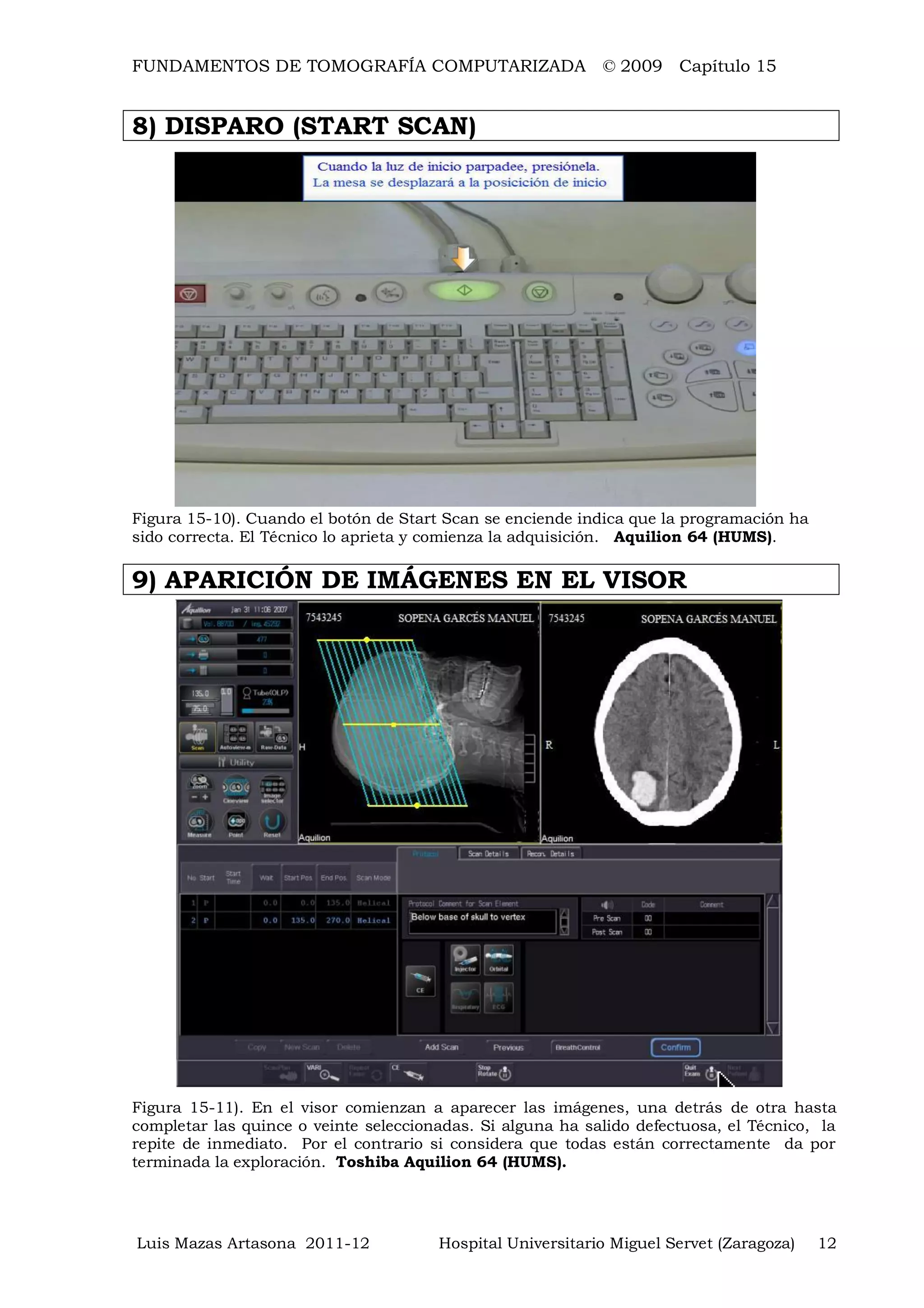 FUNDAMENTOS DE TOMOGRAFÍA COMPUTARIZADA © 2009 Capítulo 15
Luis Mazas Artasona 2011-12 Hospital Universitario Miguel Servet (Zaragoza) 12
8) DISPARO (START SCAN)
Figura 15-10). Cuando el botón de Start Scan se enciende indica que la programación ha
sido correcta. El Técnico lo aprieta y comienza la adquisición. Aquilion 64 (HUMS).
9) APARICIÓN DE IMÁGENES EN EL VISOR
Figura 15-11). En el visor comienzan a aparecer las imágenes, una detrás de otra hasta
completar las quince o veinte seleccionadas. Si alguna ha salido defectuosa, el Técnico, la
repite de inmediato. Por el contrario si considera que todas están correctamente da por
terminada la exploración. Toshiba Aquilion 64 (HUMS).
 