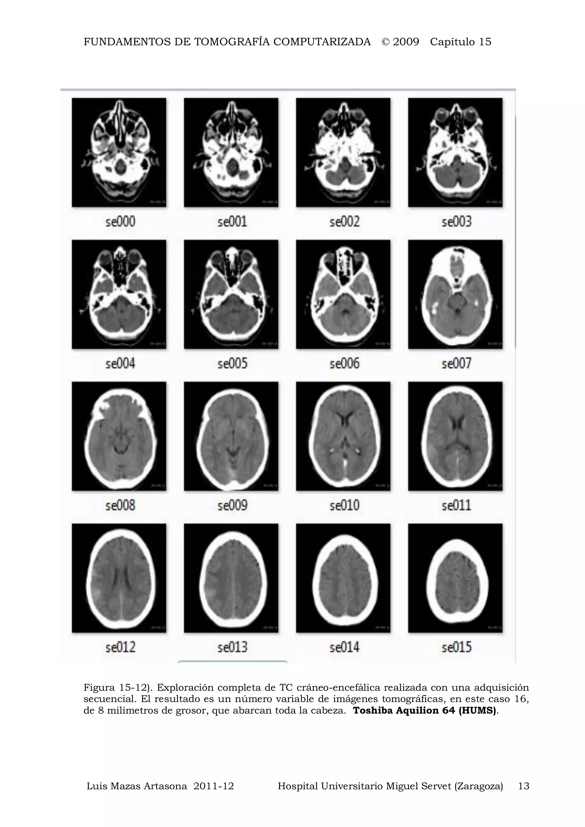 FUNDAMENTOS DE TOMOGRAFÍA COMPUTARIZADA © 2009 Capítulo 15
Luis Mazas Artasona 2011-12 Hospital Universitario Miguel Servet (Zaragoza) 13
Figura 15-12). Exploración completa de TC cráneo-encefálica realizada con una adquisición
secuencial. El resultado es un número variable de imágenes tomográficas, en este caso 16,
de 8 milímetros de grosor, que abarcan toda la cabeza. Toshiba Aquilion 64 (HUMS).
 