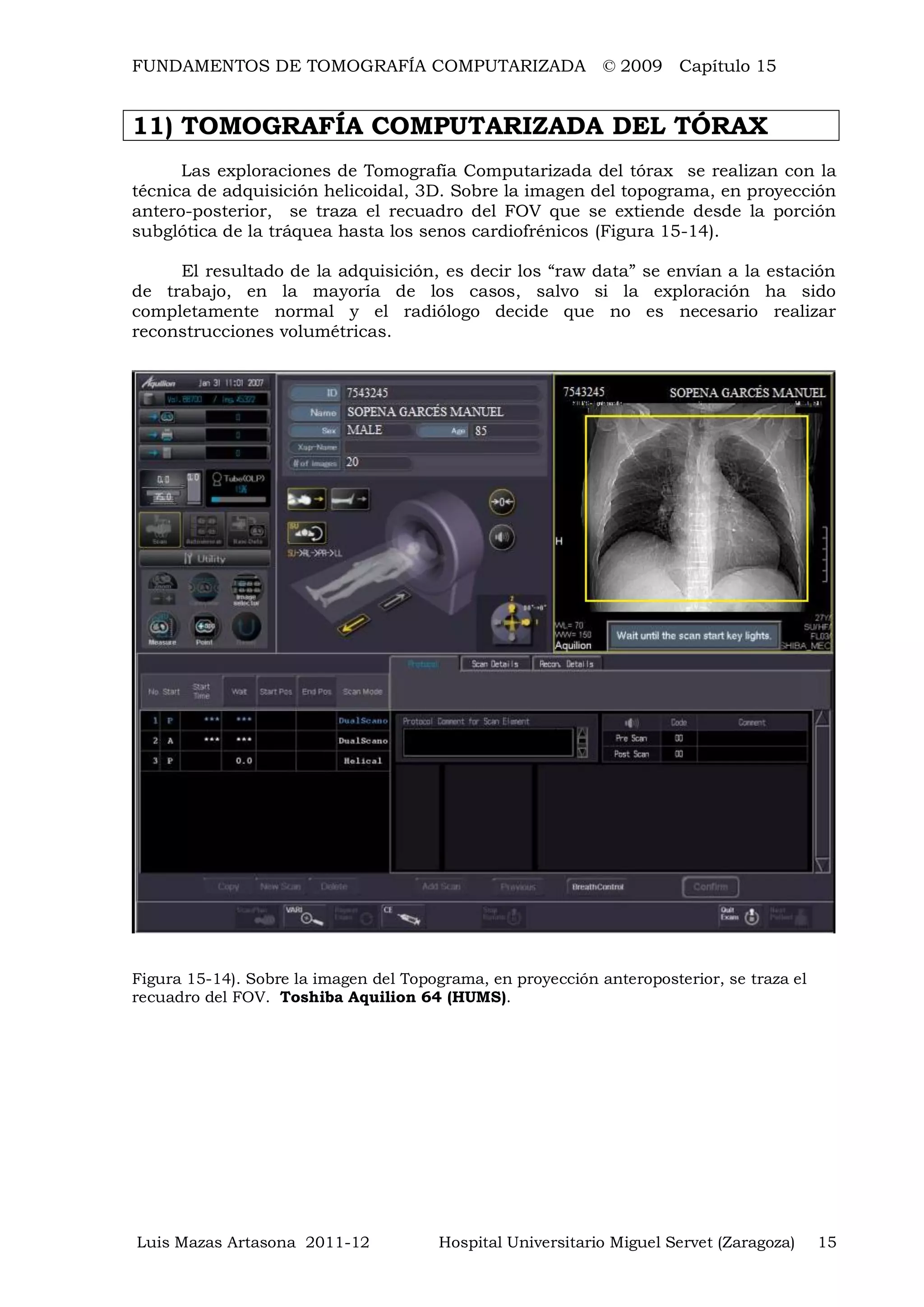 FUNDAMENTOS DE TOMOGRAFÍA COMPUTARIZADA © 2009 Capítulo 15
Luis Mazas Artasona 2011-12 Hospital Universitario Miguel Servet (Zaragoza) 15
11) TOMOGRAFÍA COMPUTARIZADA DEL TÓRAX
Las exploraciones de Tomografía Computarizada del tórax se realizan con la
técnica de adquisición helicoidal, 3D. Sobre la imagen del topograma, en proyección
antero-posterior, se traza el recuadro del FOV que se extiende desde la porción
subglótica de la tráquea hasta los senos cardiofrénicos (Figura 15-14).
El resultado de la adquisición, es decir los “raw data” se envían a la estación
de trabajo, en la mayoría de los casos, salvo si la exploración ha sido
completamente normal y el radiólogo decide que no es necesario realizar
reconstrucciones volumétricas.
Figura 15-14). Sobre la imagen del Topograma, en proyección anteroposterior, se traza el
recuadro del FOV. Toshiba Aquilion 64 (HUMS).
 