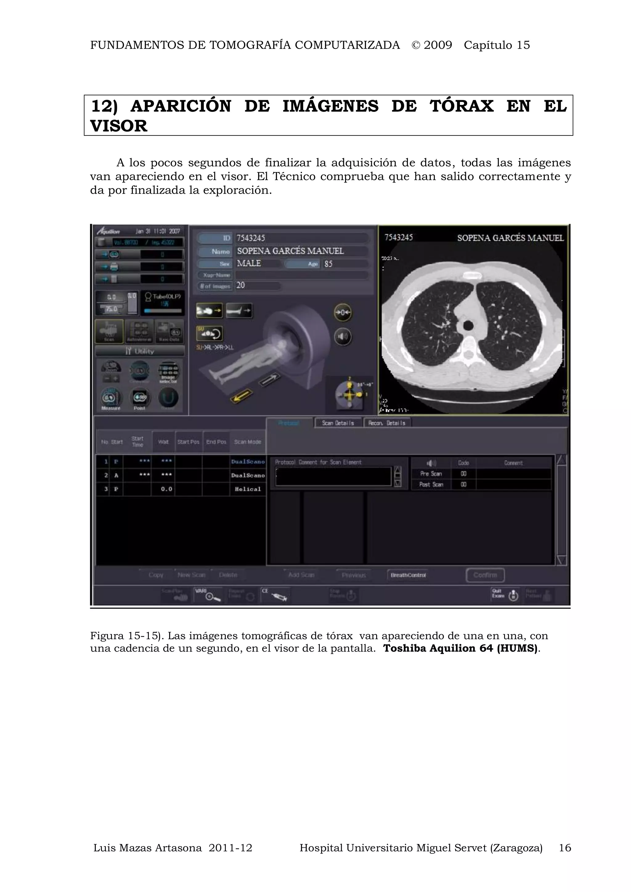 FUNDAMENTOS DE TOMOGRAFÍA COMPUTARIZADA © 2009 Capítulo 15
Luis Mazas Artasona 2011-12 Hospital Universitario Miguel Servet (Zaragoza) 16
12) APARICIÓN DE IMÁGENES DE TÓRAX EN EL
VISOR
A los pocos segundos de finalizar la adquisición de datos, todas las imágenes
van apareciendo en el visor. El Técnico comprueba que han salido correctamente y
da por finalizada la exploración.
Figura 15-15). Las imágenes tomográficas de tórax van apareciendo de una en una, con
una cadencia de un segundo, en el visor de la pantalla. Toshiba Aquilion 64 (HUMS).
 