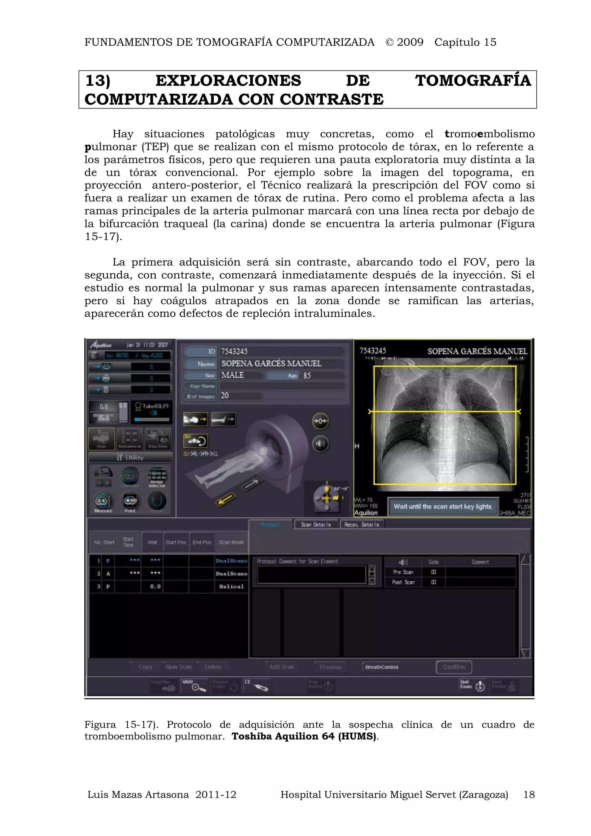 FUNDAMENTOS DE TOMOGRAFÍA COMPUTARIZADA © 2009 Capítulo 15
Luis Mazas Artasona 2011-12 Hospital Universitario Miguel Servet (Zaragoza) 18
13) EXPLORACIONES DE TOMOGRAFÍA
COMPUTARIZADA CON CONTRASTE
Hay situaciones patológicas muy concretas, como el tromoembolismo
pulmonar (TEP) que se realizan con el mismo protocolo de tórax, en lo referente a
los parámetros físicos, pero que requieren una pauta exploratoria muy distinta a la
de un tórax convencional. Por ejemplo sobre la imagen del topograma, en
proyección antero-posterior, el Técnico realizará la prescripción del FOV como si
fuera a realizar un examen de tórax de rutina. Pero como el problema afecta a las
ramas principales de la arteria pulmonar marcará con una línea recta por debajo de
la bifurcación traqueal (la carina) donde se encuentra la arteria pulmonar (Figura
15-17).
La primera adquisición será sin contraste, abarcando todo el FOV, pero la
segunda, con contraste, comenzará inmediatamente después de la inyección. Si el
estudio es normal la pulmonar y sus ramas aparecen intensamente contrastadas,
pero si hay coágulos atrapados en la zona donde se ramifican las arterias,
aparecerán como defectos de repleción intraluminales.
Figura 15-17). Protocolo de adquisición ante la sospecha clínica de un cuadro de
tromboembolismo pulmonar. Toshiba Aquilion 64 (HUMS).
 